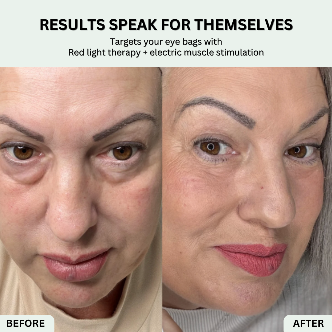 EYECLR® 2-in-1 Red Light Therapy + EMS To Erase Eye Bags