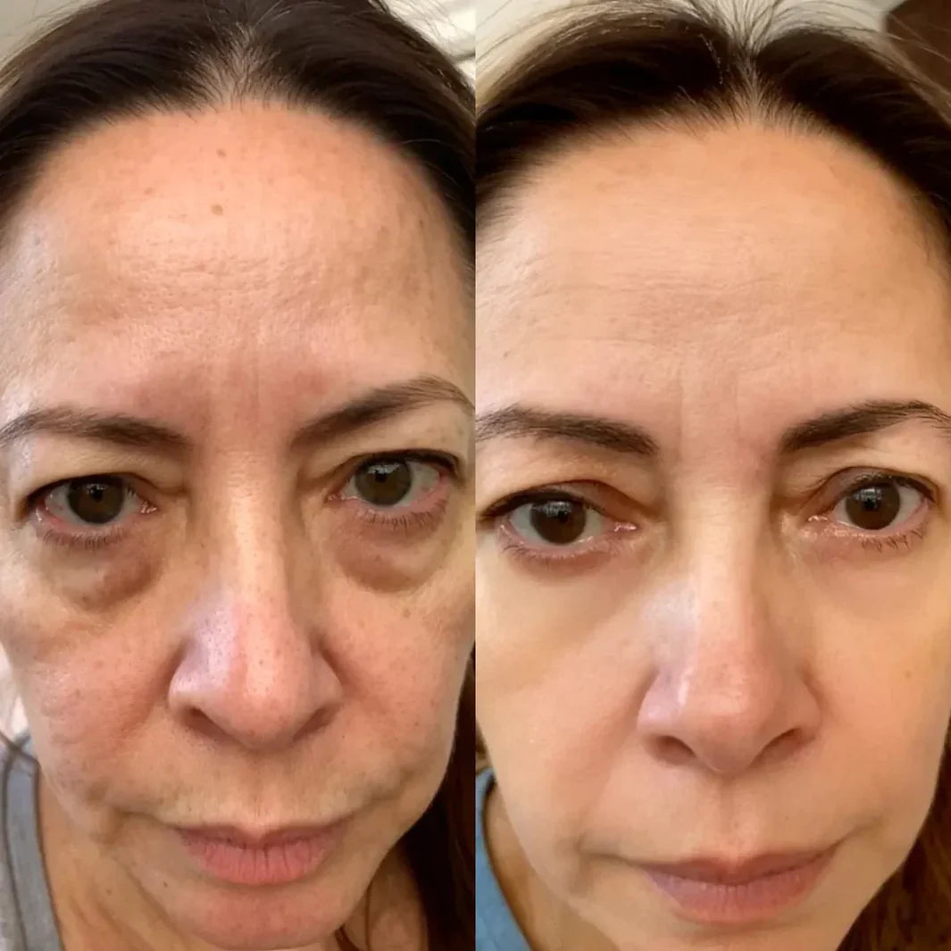 EYECLR® 2-in-1 Red Light Therapy + EMS To Erase Eye Bags