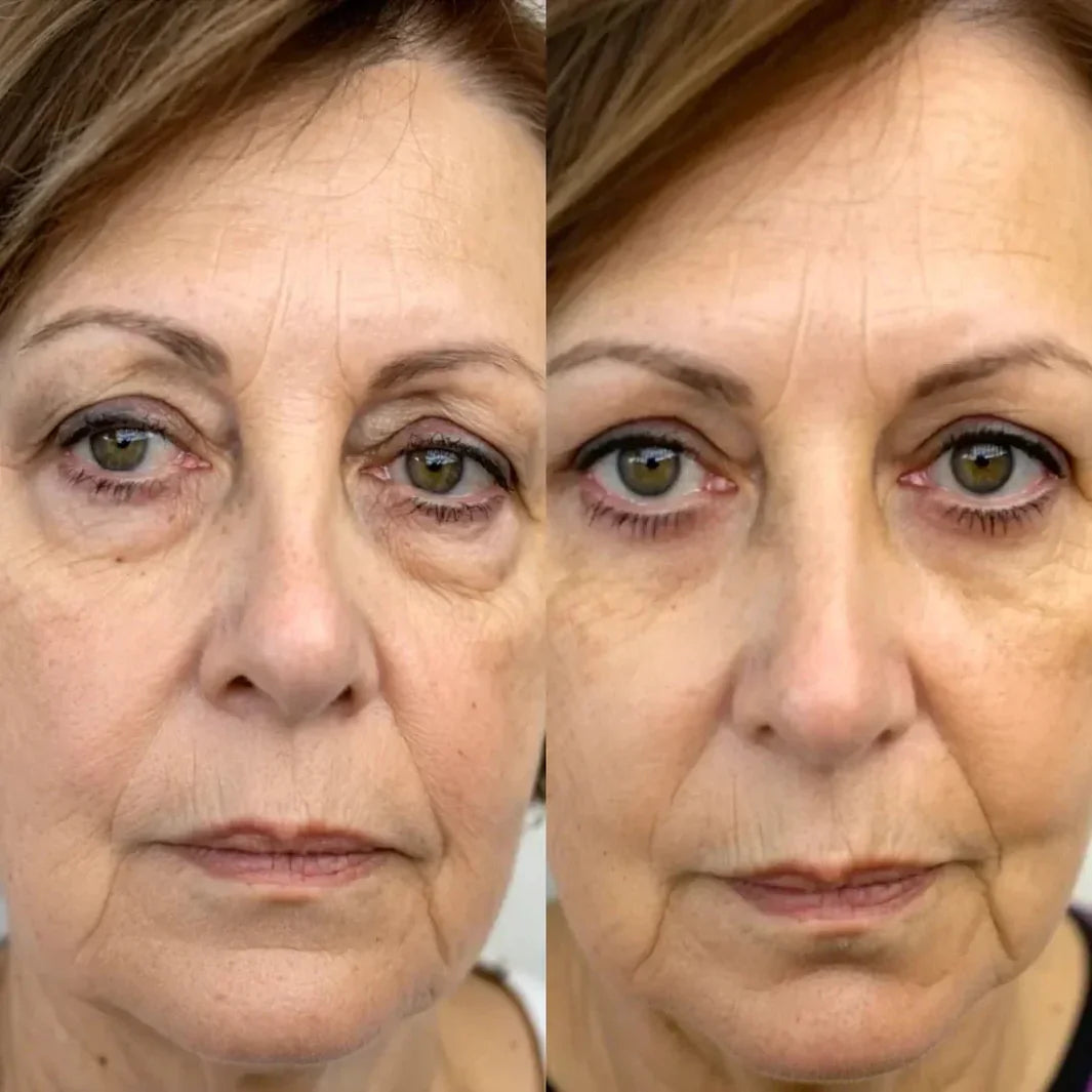 EYECLR® 2-in-1 Red Light Therapy + EMS To Erase Eye Bags